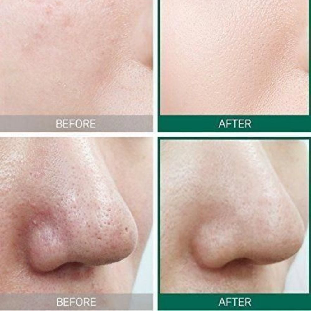 93-2_c0b3fd5e76584f87b39a15ed5d31871c_1024x1024 Peel da đúng cách giúp cải thiện tình trạng da