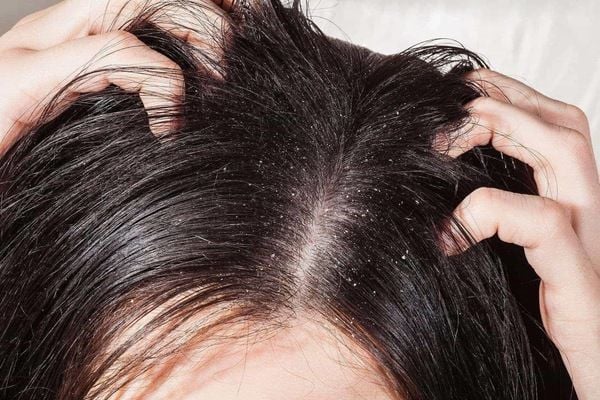 Người đang gãi đầu, tóc đen, có nhiều gàu trên da đầu, hai tay đặt lên tóc.