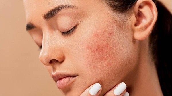 Cà chua giảm mụn và vết thâm hiệu quả
