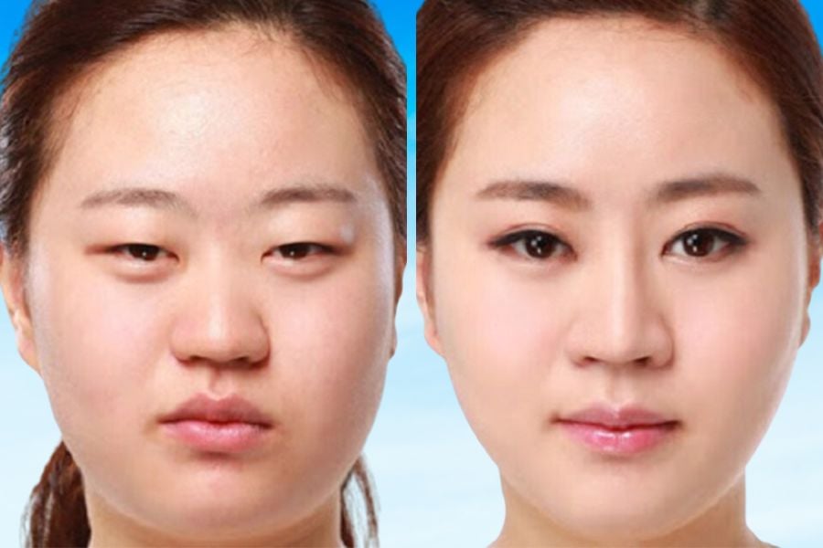 sụp mí là gì
