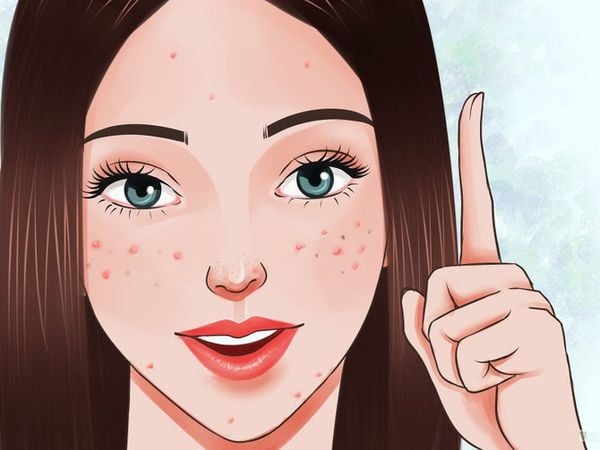 Hình minh họa một người với làn da có mụn, tóc dài, đang giơ một ngón tay lên và mỉm cười.