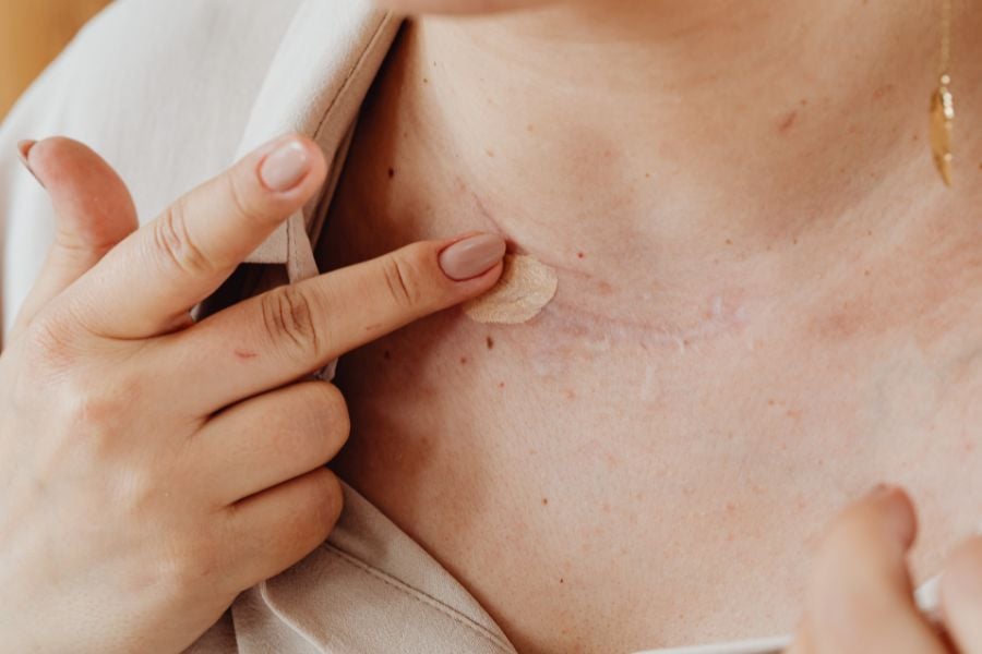 Kem che khuyết điểm có che được nốt ruồi không?