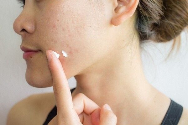 Retinol giúp cải thiện tình trạng mụn trứng cá trên da