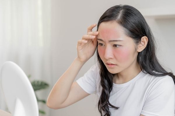 Người phụ nữ mặc áo trắng nhìn vào gương, trán và má ửng đỏ, có vẻ lo lắng về tình trạng da của mình.