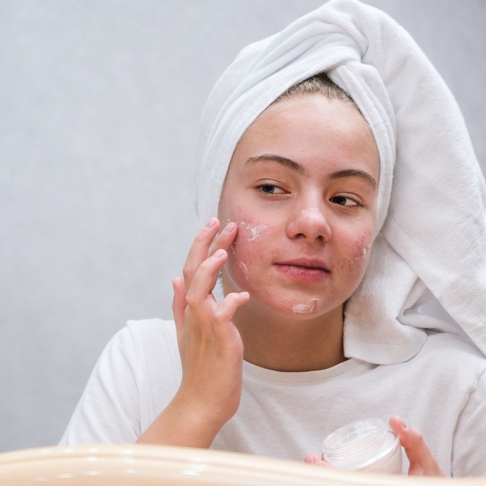 Gel trị mụn là gì